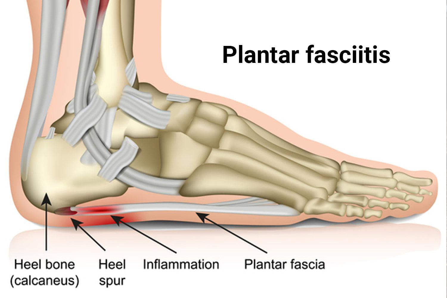 HOW NUUSOL HELPS WITH PLANTAR FASCIITIS